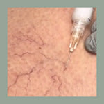 Sclerotherapy (30mins)