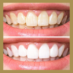 Model - Teeth Whitening