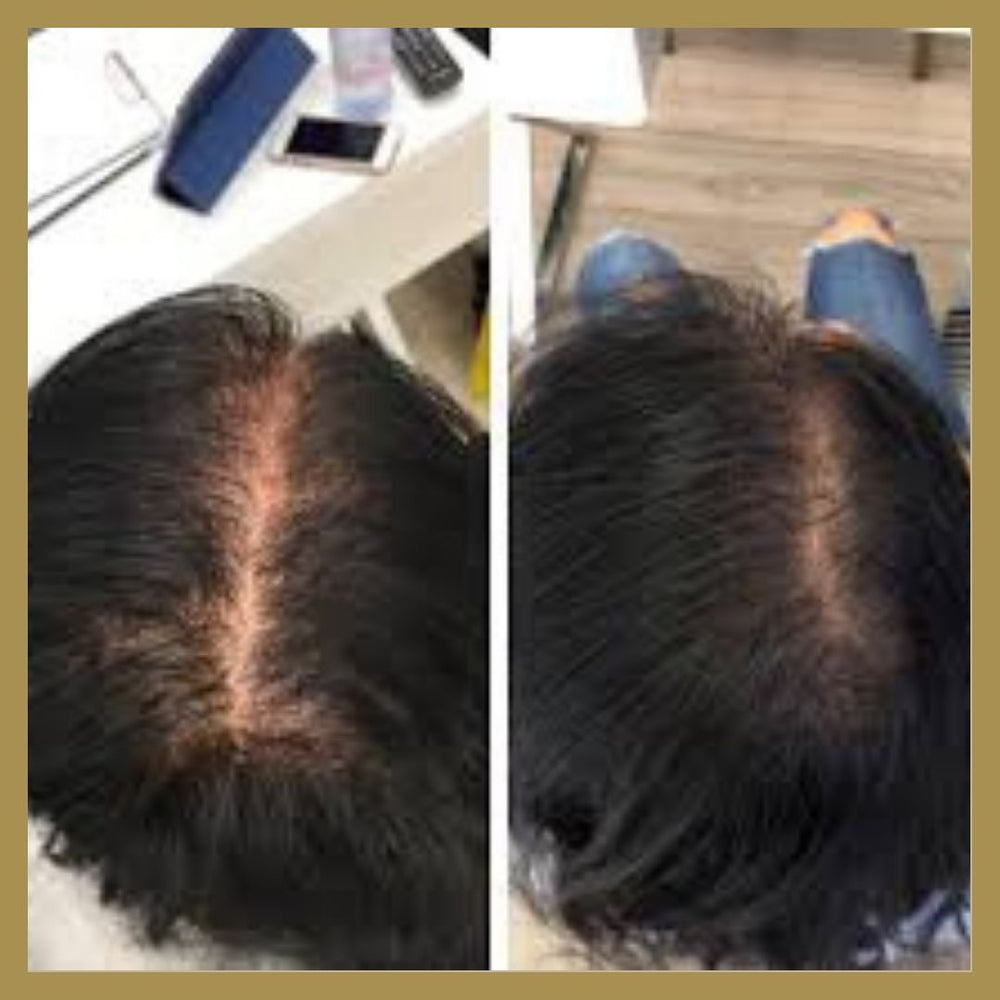 Model - PRP Hair Loss Treatment